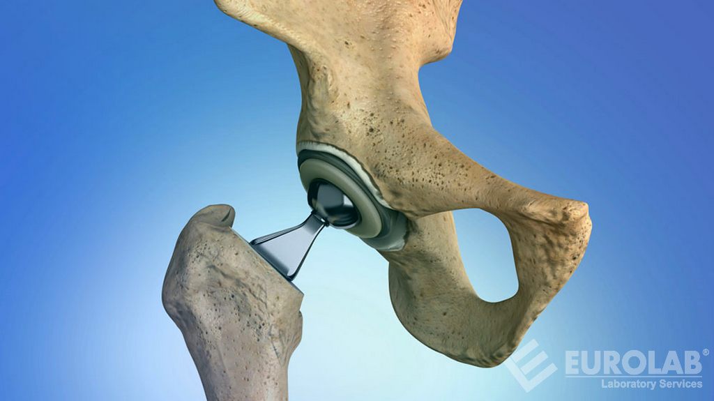 Špeciálne požiadavky na implantáty bedrového kĺbu ISO 21535